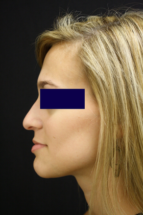 Rhinoplasty: Case 1 - Before