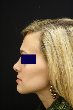Rhinoplasty: Case 1 - After