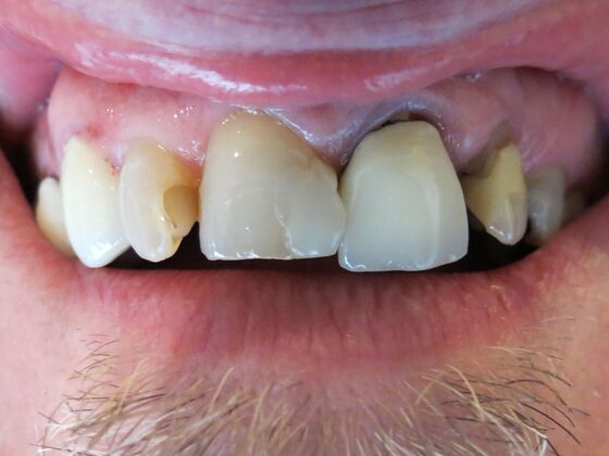 Smile Makeovers, actual cases of our dentists, no special lighting or editing Case 4 - Before