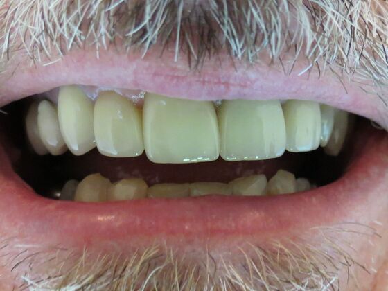 Smile Makeovers, actual cases of our dentists, no special lighting or editing Case 4 - After