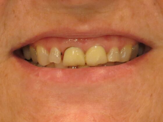 Smile Makeovers, actual cases of our dentists, no special lighting or editing Case 6 - Before