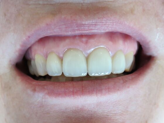 Smile Makeovers, actual cases of our dentists, no special lighting or editing Case 6 - After