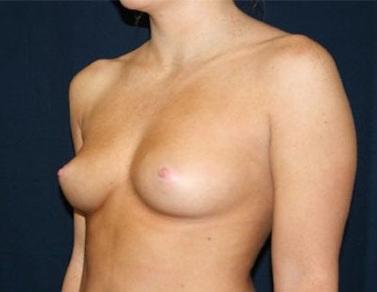 Breast Augmentation*: Case 11 - Side Before