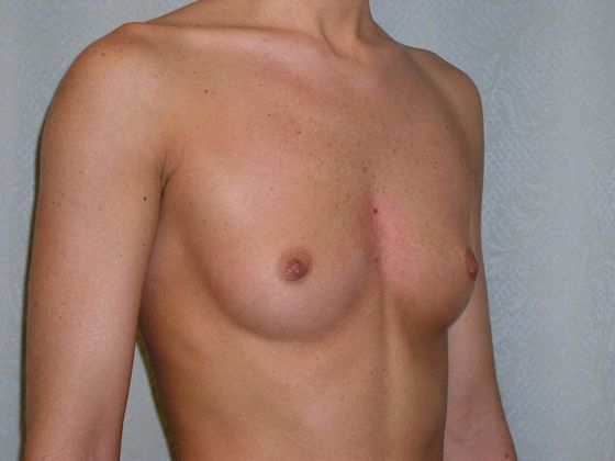 Breast Augmentation*: Case 4 - Side Before