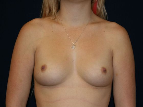 Breast Augmentation*: Case 13 - Front Before