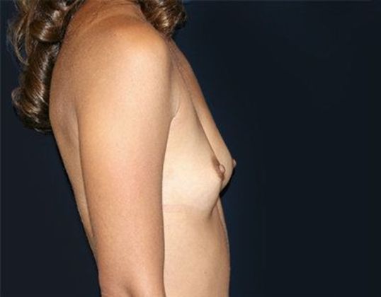 Breast Augmentation*: Case 20 - Side Before