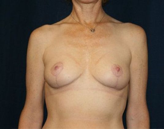 Breast Lift*: Case 5 - Front After