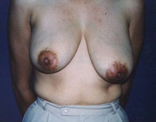 Breast Lift*: Case  6 - Front Before