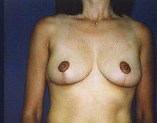Breast Lift*: Case  6 - Front After