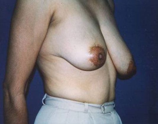 Breast Lift*: Case  6 - Side Before