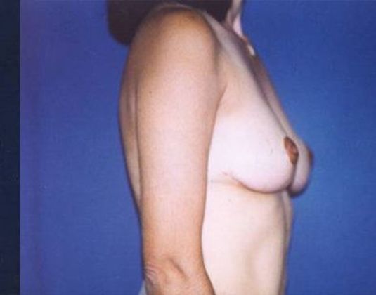 Breast Lift*: Case  6 - Side After