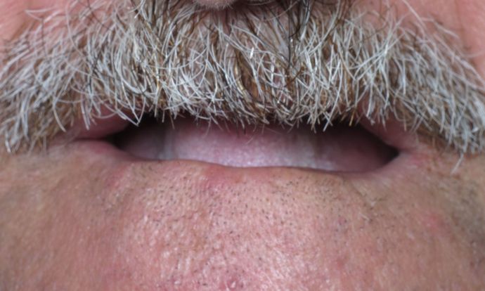 Full Mouth Implants: Case 6 - Before Smile