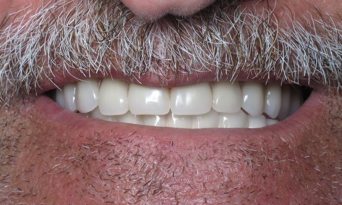 Full Mouth Implants: Case 6 - After Smile