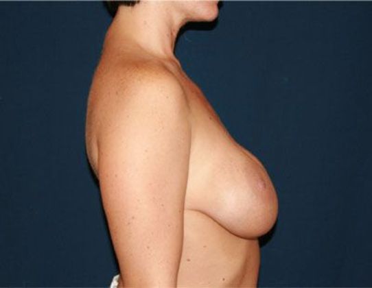 Breast Lift With Augmentation*: Case 5 - Side Before