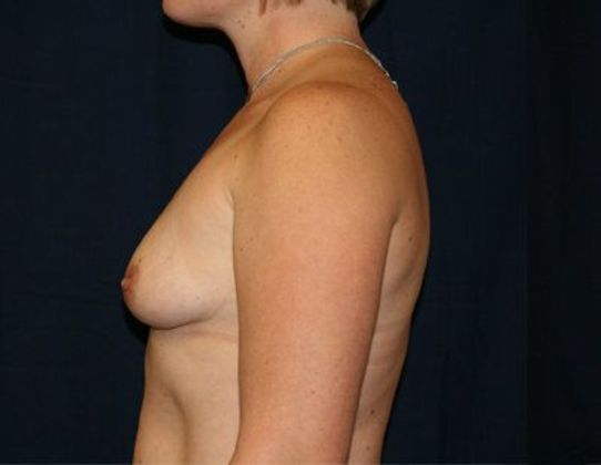 Breast Lift With Augmentation*: Case 6 - Side Before