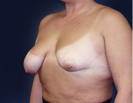 Breast Lift With Augmentation*: Case 27 - Side Before
