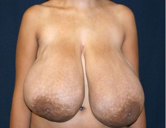 Breast Reduction*: Case 3 - Front Before