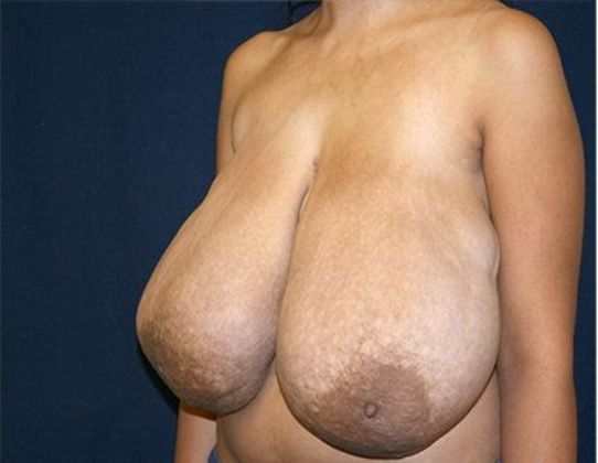 Breast Reduction*: Case 3 - Side Before