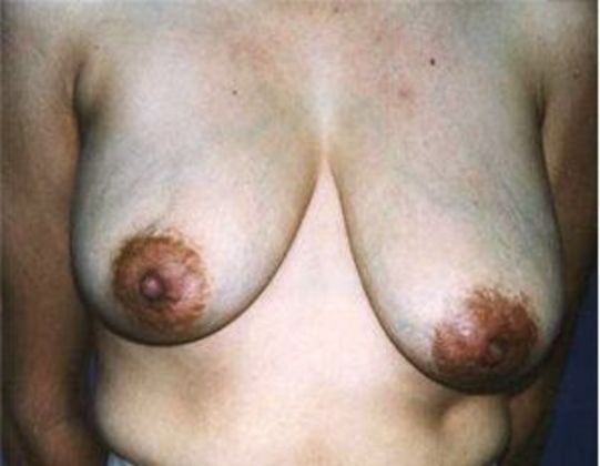 Breast Reduction*: Case 4 - Front Before