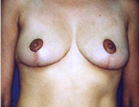 Breast Reduction*: Case 4 - Front After