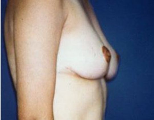 Breast Reduction*: Case 4 - Side After
