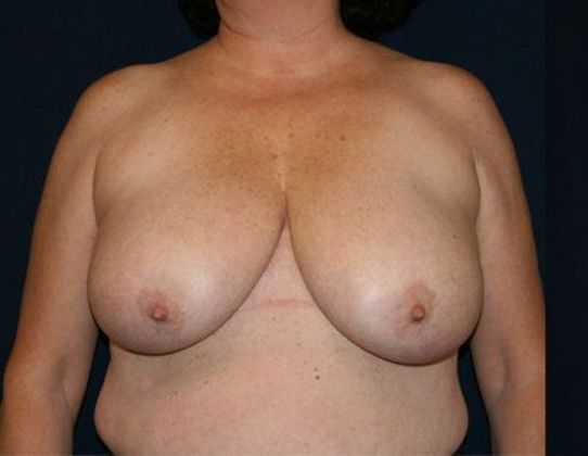 Breast Reduction*: Case 5 - Front Before