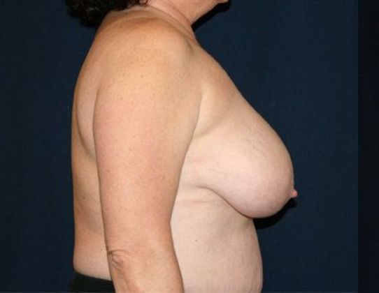 Breast Reduction*: Case 5 - Side Before