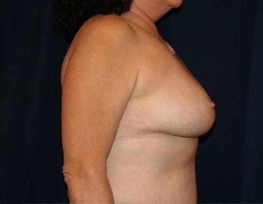 Breast Reduction*: Case 5 - Side After