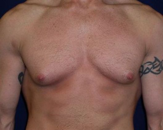 Breast Reduction - Reno, NV - Lake Tahoe, NV - Dr. James Murphy