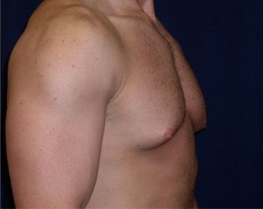 Male Breast Reduction*: Case 1 - Side Before