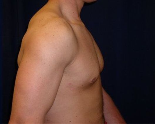 Male Breast Reduction*: Case 1 - Side After