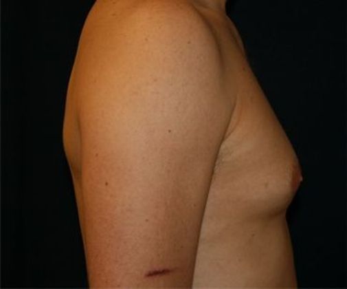 Male Breast Reduction*: Case 2 - Side Before