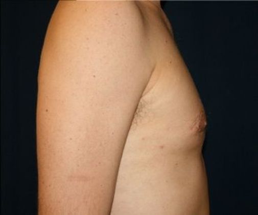 Male Breast Reduction*: Case 2 - Side After