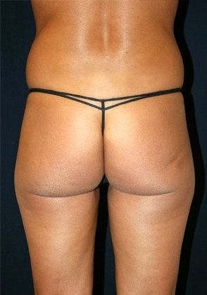 Liposuction & Safe Lipo: Case 5 - Back Before
