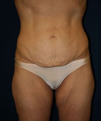 Tummy Tuck*: Case 7 - Front Before