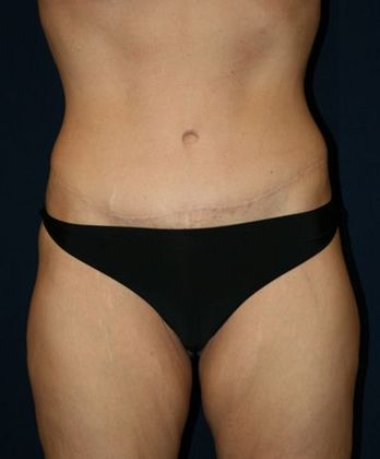 Tummy Tuck*: Case 7 - Front After