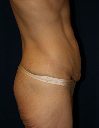 Tummy Tuck*: Case 7 - Side Before