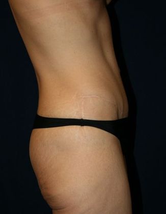 Tummy Tuck*: Case 7 - Side After