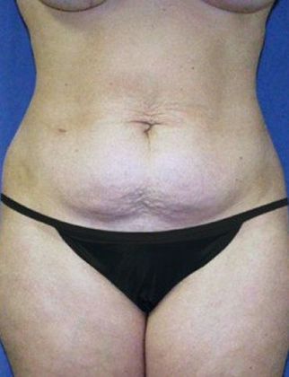 Tummy Tuck*: Case 8 - Front Before