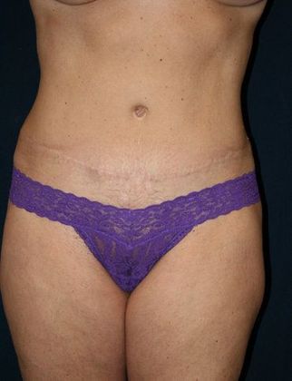 Tummy Tuck*: Case 8 - Front After