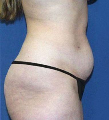 Tummy Tuck*: Case 8 - Side Before