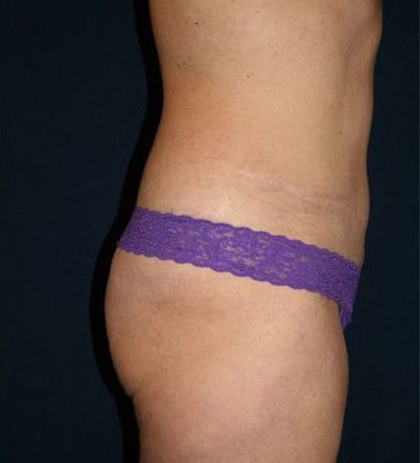 Tummy Tuck*: Case 8 - Side After