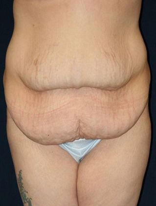 Tummy Tuck*: Case 9 - Front Before
