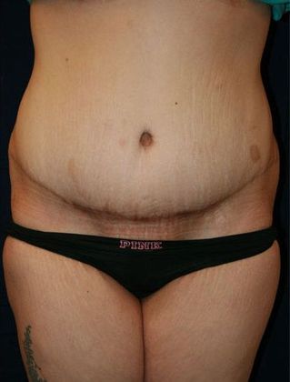 Tummy Tuck*: Case 9 - Front After