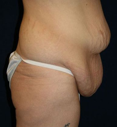 Tummy Tuck*: Case 9 - Side Before