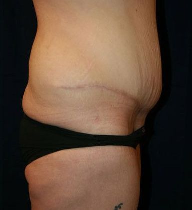 Tummy Tuck*: Case 9 - Side After