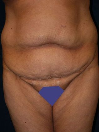 Tummy Tuck*: Case 10 - Front Before