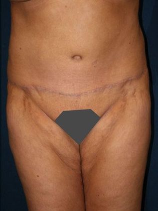 Tummy Tuck*: Case 10 - Front After