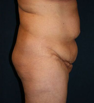 Tummy Tuck*: Case 10 - Side Before
