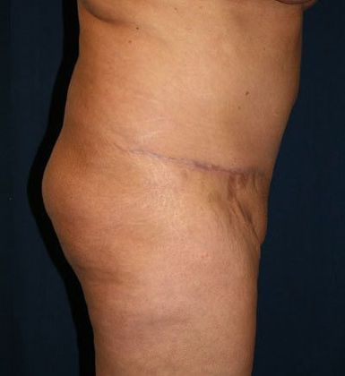 Tummy Tuck*: Case 10 - Side After